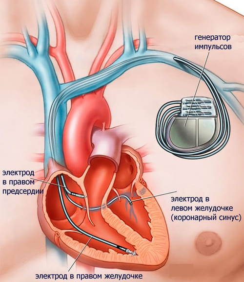 расположение электродов при сердечной ресинхронизирующей терапии