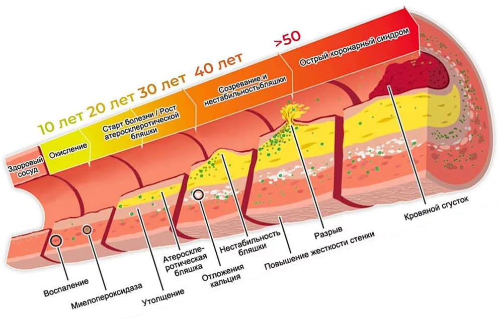 этапы атеросклероза в стенке артерии