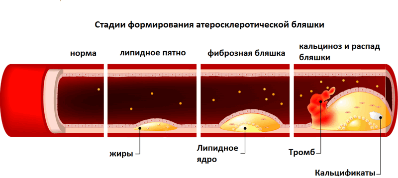 стадии формирования атеросклеротической бляшки