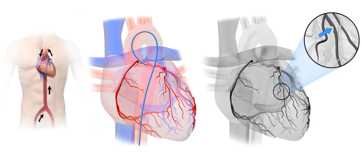 проведение катетера к сердцу через бедренную артерию и выполнение коронарографии