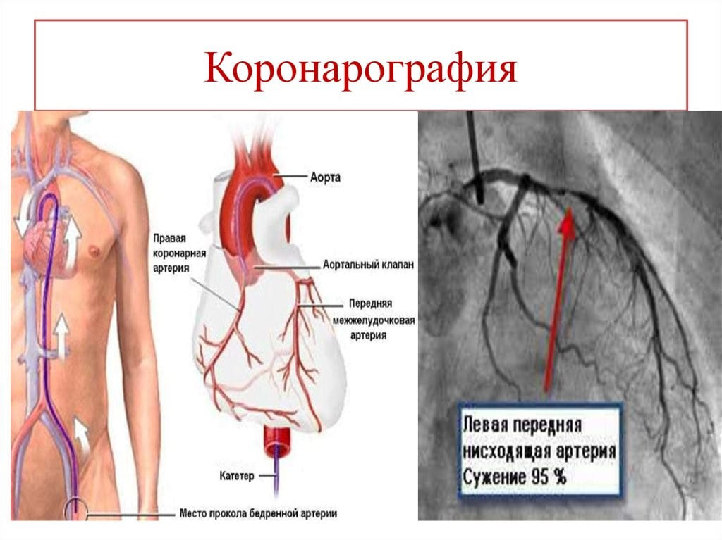 коронарография и выявление сужения в коронарной артерии