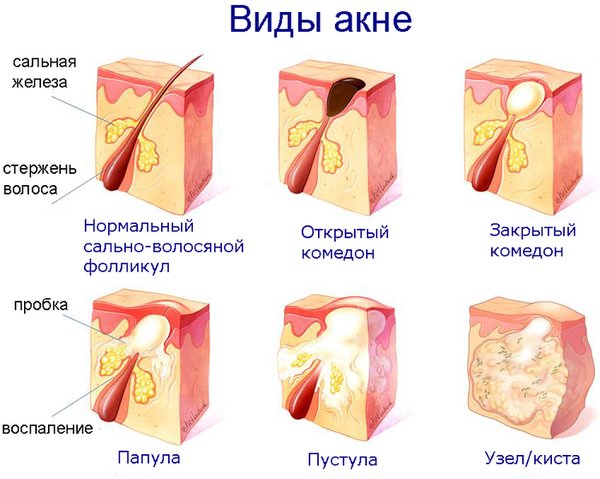 виды акне