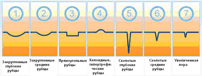 виды рубцов