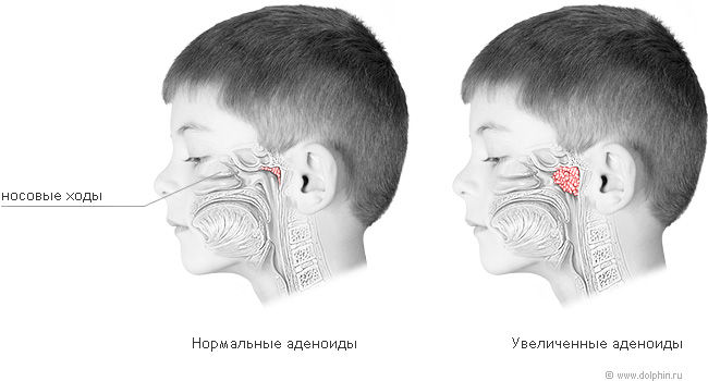 расположение носоглоточной миндалины, аденоиды