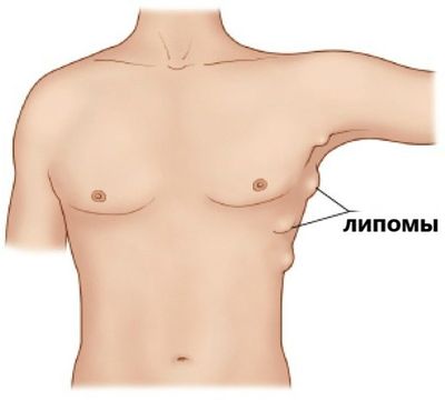 липома (жировик) на теле