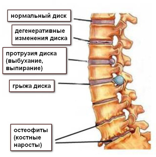 развитие остеохондроза позвоночника