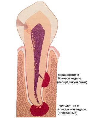 периодонтит